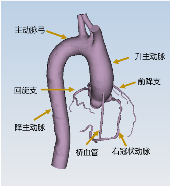 冠状动脉搭桥手术虚拟仿真APP助力精准外科
的图5